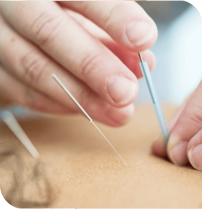 Akupunktura